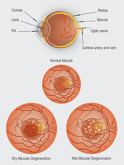 Age Related Macular Degeneration